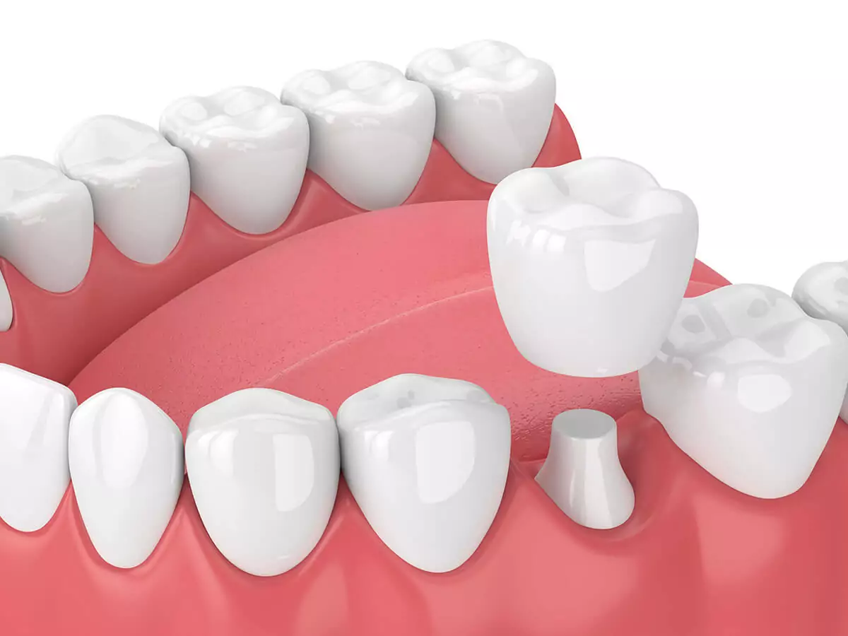 Dental Crowns and Bridges
